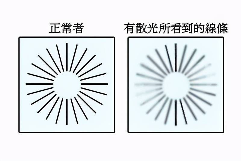 散光是怎么形成的？青少年儿童需不需要矫正？