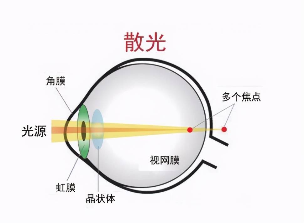 散光是怎么形成的？青少年儿童需不需要矫正？