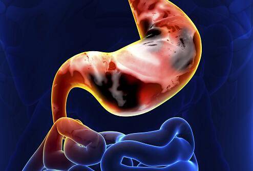 急性肠胃炎真的可以自愈吗？