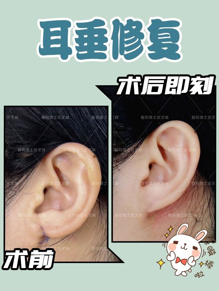 余文林详解：耳垂裂、耳垂肥大、耳垂缺损怎么修复？