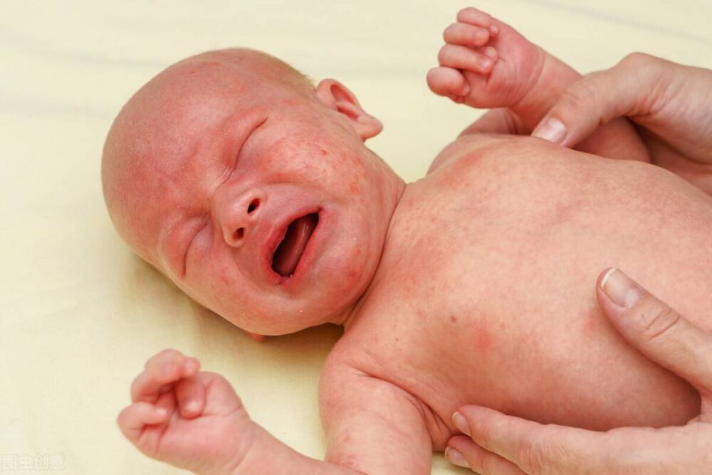 宝宝得了湿疹有哪些症状？还能不能打预防针？医生告诉你答案