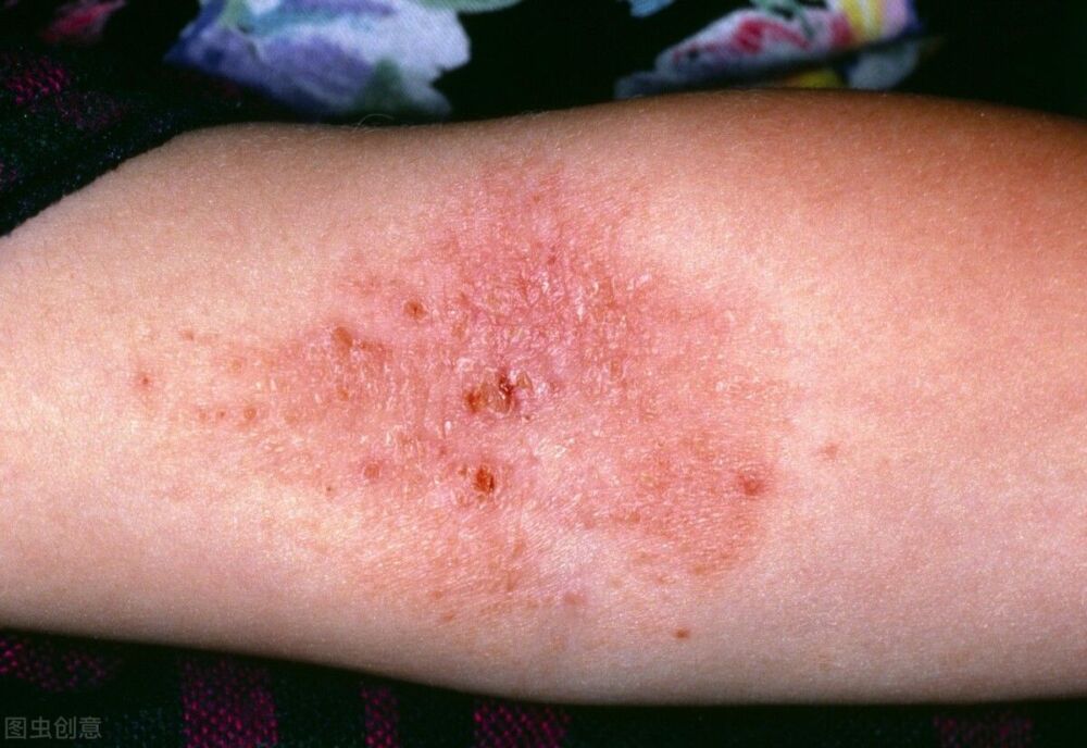 为什么湿疹反复不易根除？治疗湿疹并不难，关键在于这一点