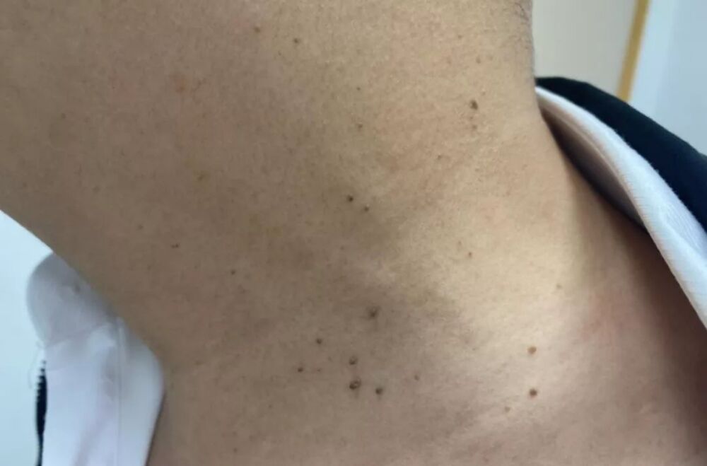 身体长了密密麻麻的皮疹，像斑像痣还像粉刺？可能跟HPV有关
