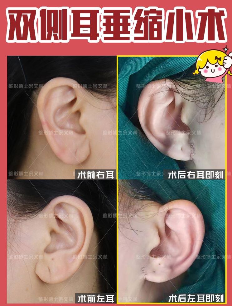 余文林详解：耳垂裂、耳垂肥大、耳垂缺损怎么修复？