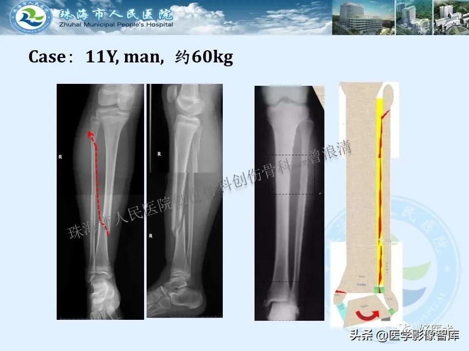 独立值班必备：66张胫骨骨折图解，不怕主任提问了