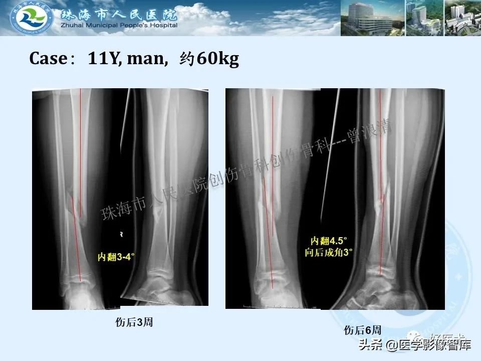 独立值班必备：66张胫骨骨折图解，不怕主任提问了