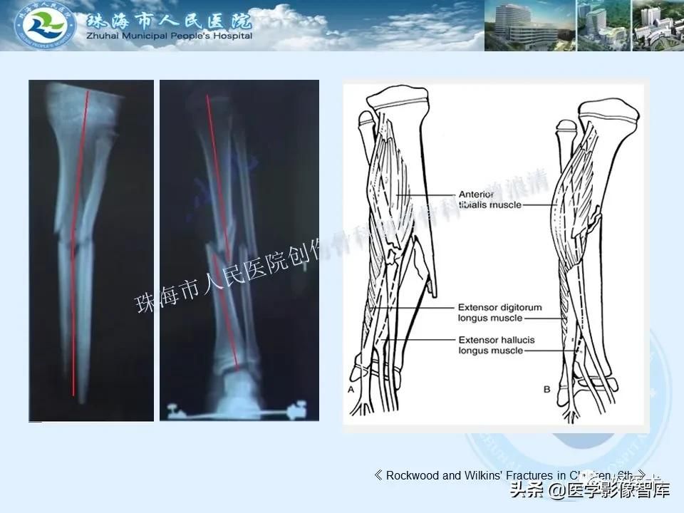 独立值班必备：66张胫骨骨折图解，不怕主任提问了