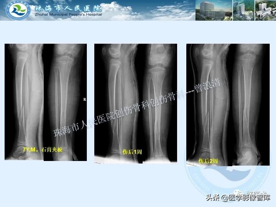 独立值班必备：66张胫骨骨折图解，不怕主任提问了