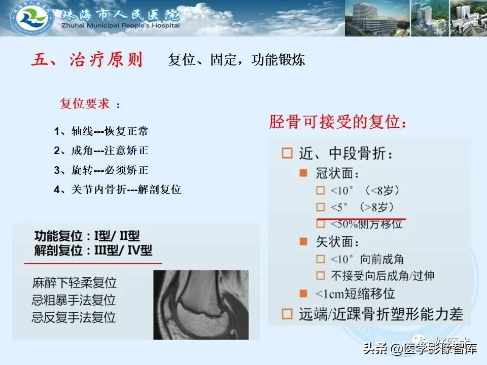 独立值班必备：66张胫骨骨折图解，不怕主任提问了