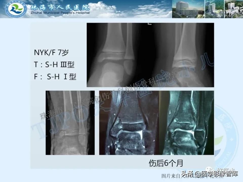 独立值班必备：66张胫骨骨折图解，不怕主任提问了