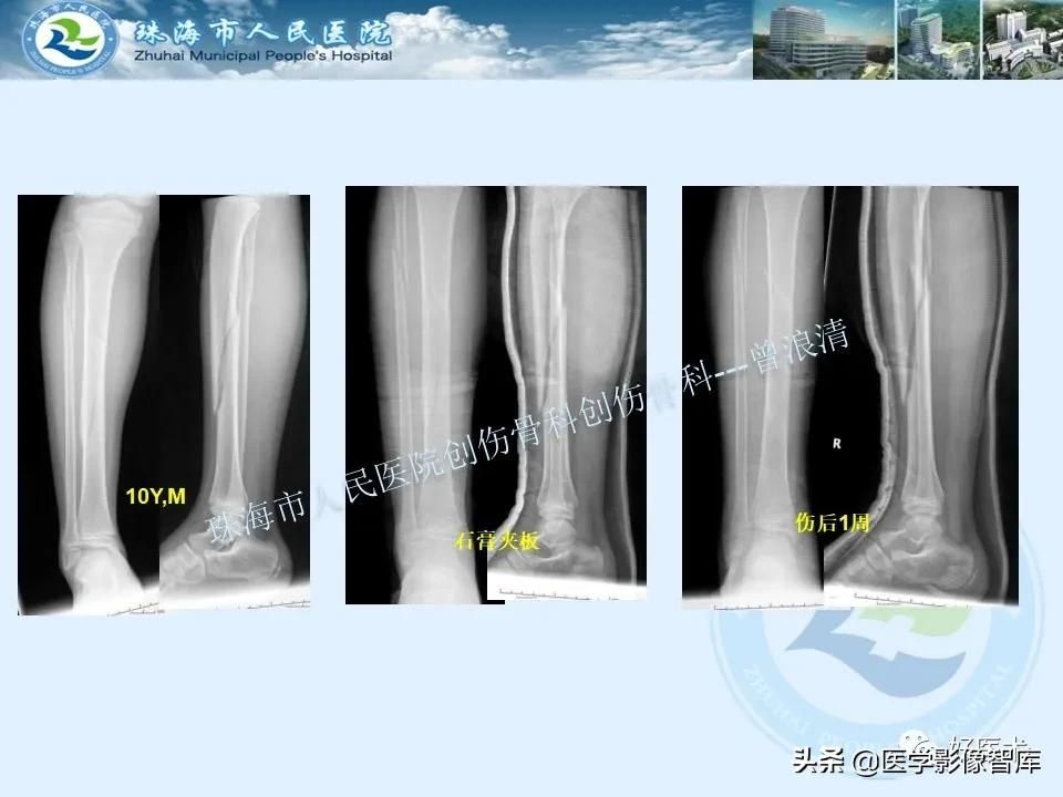 独立值班必备：66张胫骨骨折图解，不怕主任提问了