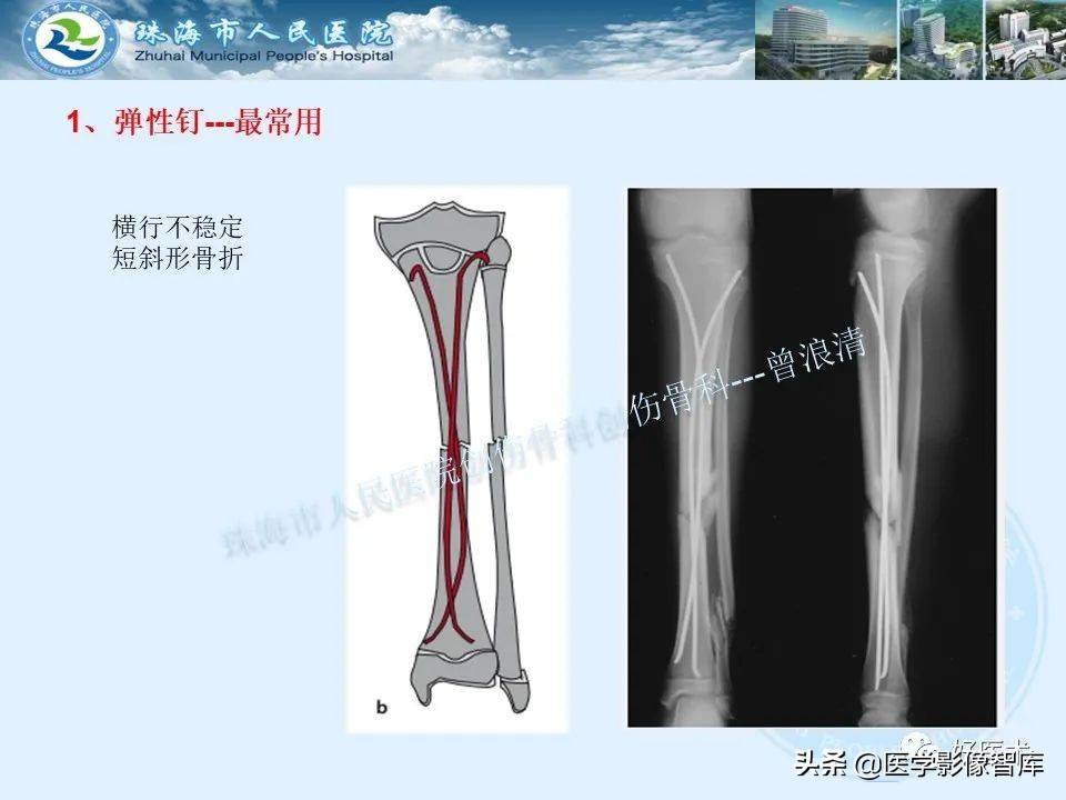 独立值班必备：66张胫骨骨折图解，不怕主任提问了