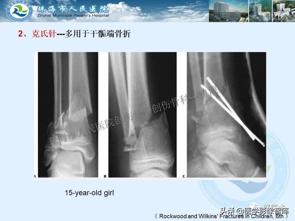 独立值班必备：66张胫骨骨折图解，不怕主任提问了