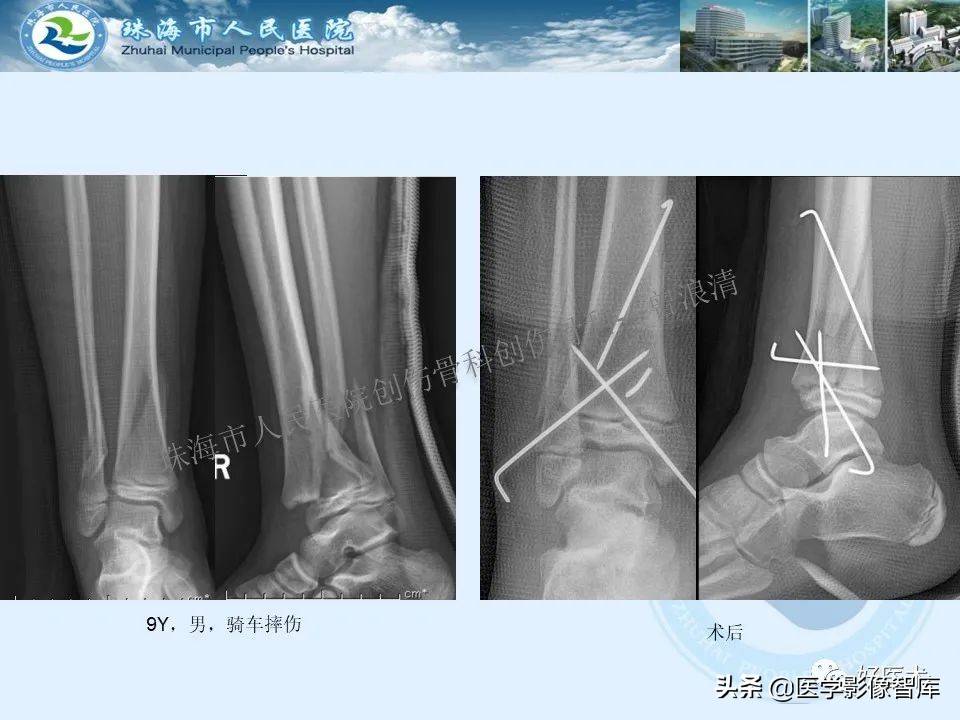 独立值班必备：66张胫骨骨折图解，不怕主任提问了