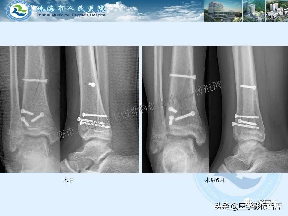 独立值班必备：66张胫骨骨折图解，不怕主任提问了