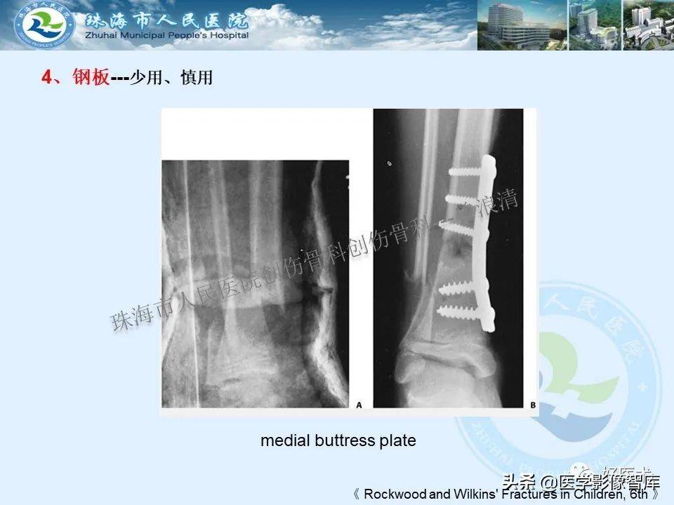 独立值班必备：66张胫骨骨折图解，不怕主任提问了