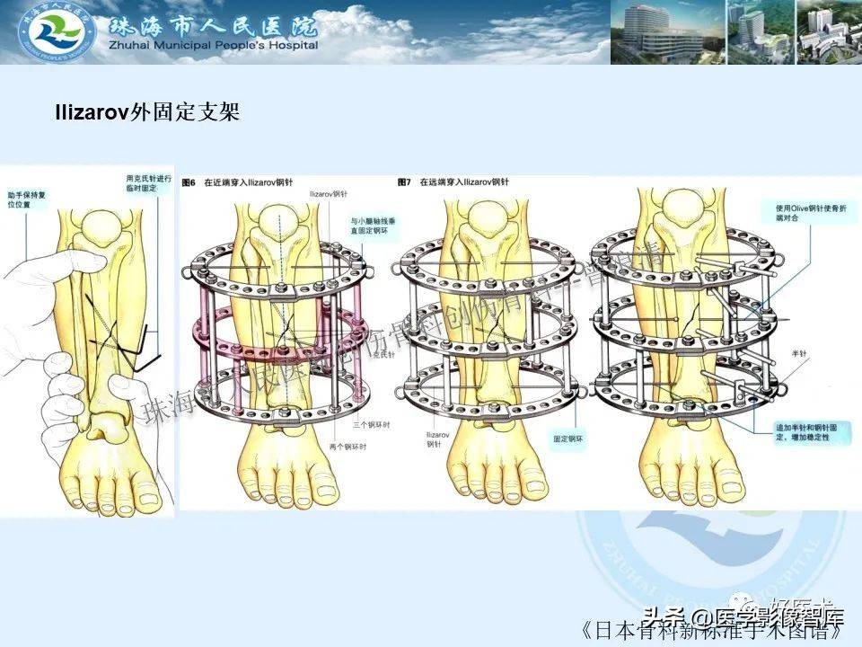 独立值班必备：66张胫骨骨折图解，不怕主任提问了