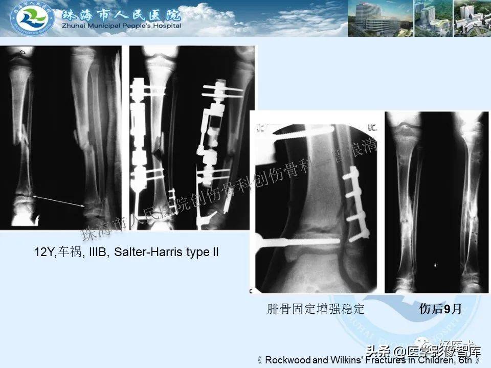 独立值班必备：66张胫骨骨折图解，不怕主任提问了