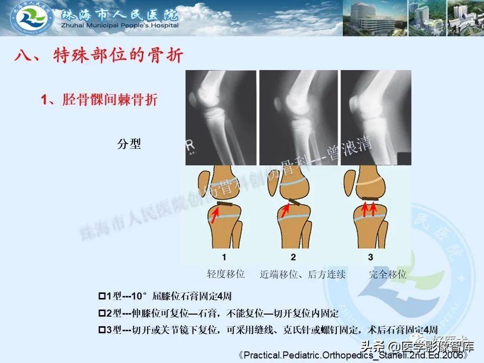 独立值班必备：66张胫骨骨折图解，不怕主任提问了