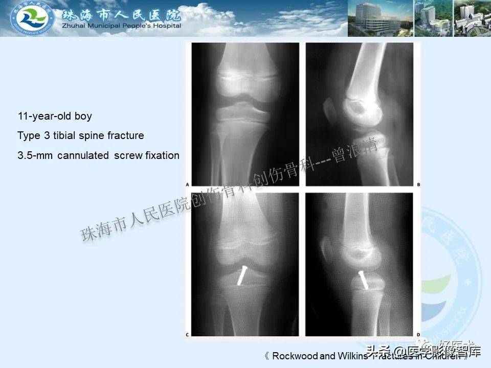 独立值班必备：66张胫骨骨折图解，不怕主任提问了