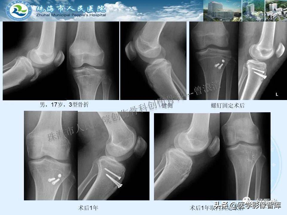 独立值班必备：66张胫骨骨折图解，不怕主任提问了