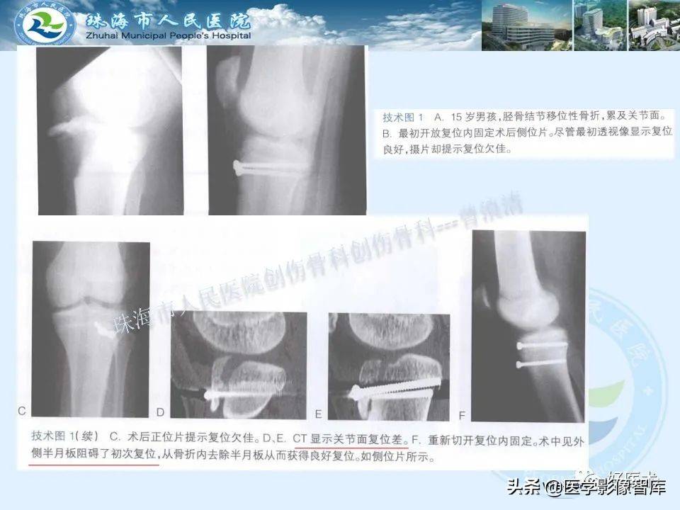 独立值班必备：66张胫骨骨折图解，不怕主任提问了