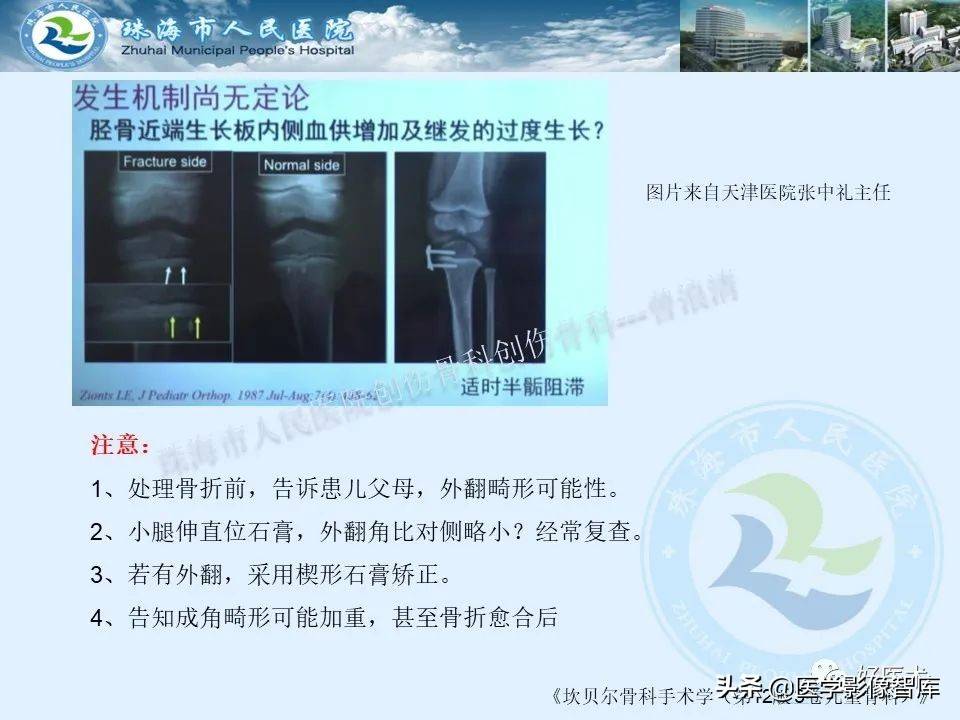 独立值班必备：66张胫骨骨折图解，不怕主任提问了