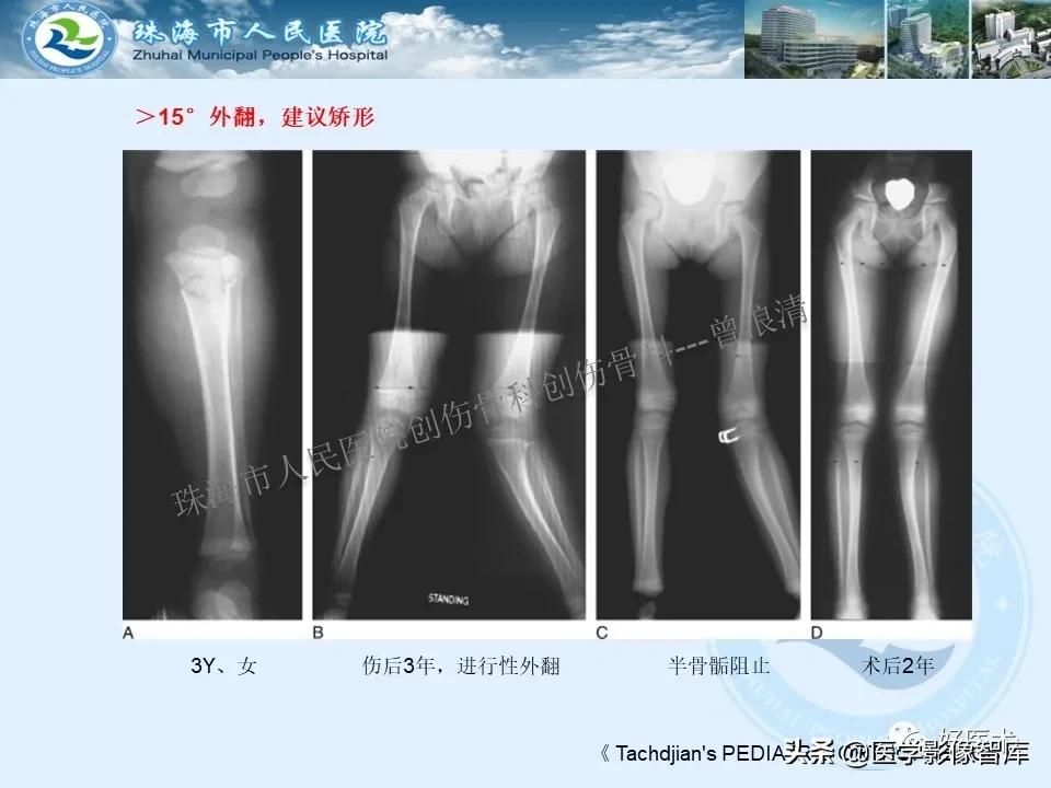 独立值班必备：66张胫骨骨折图解，不怕主任提问了