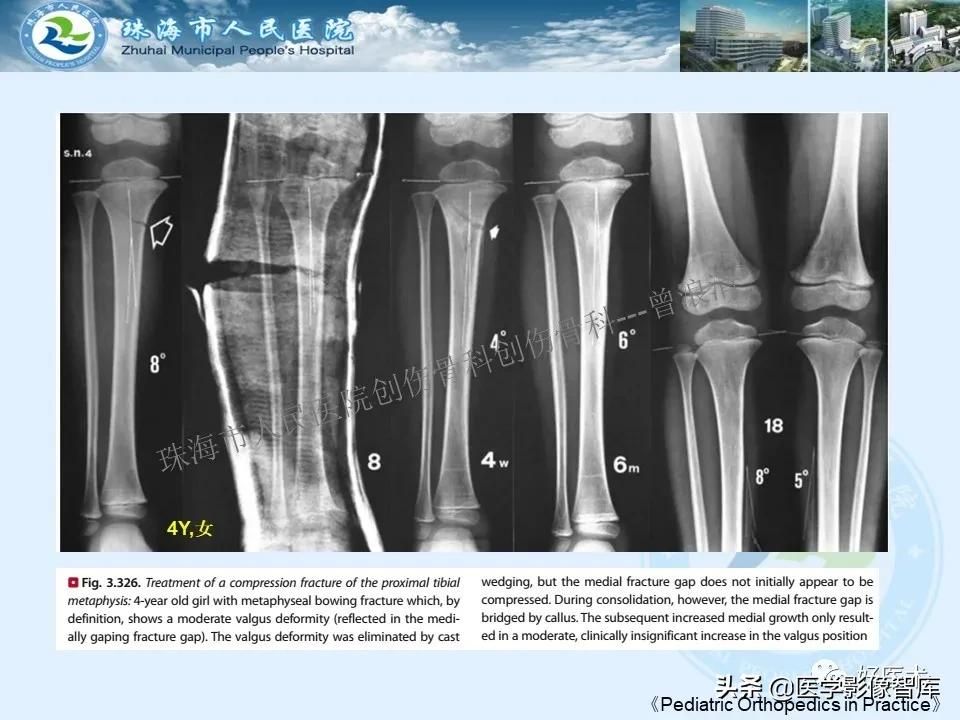独立值班必备：66张胫骨骨折图解，不怕主任提问了