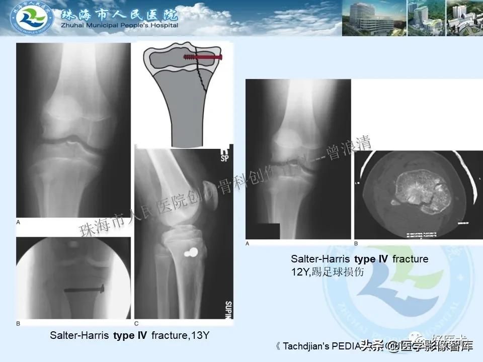 独立值班必备：66张胫骨骨折图解，不怕主任提问了