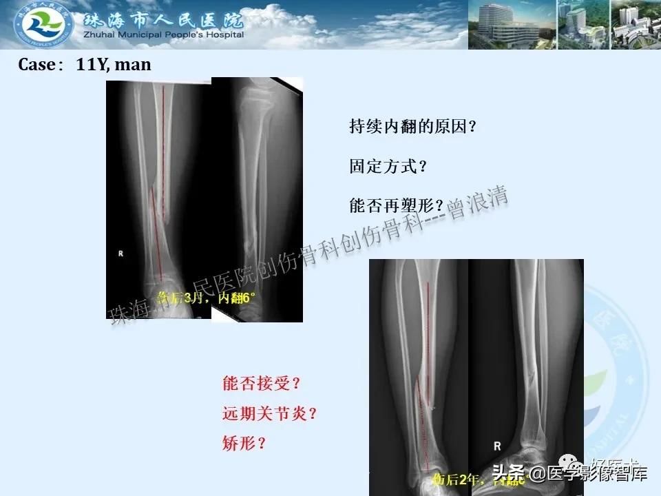 独立值班必备：66张胫骨骨折图解，不怕主任提问了