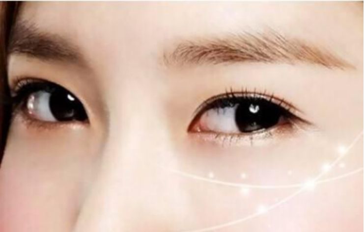 想要做双眼皮手术有哪些方法？看完这篇文章你就知道了