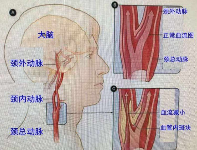 为什么颈动脉容易堵塞，该如何预防？医生讲的通俗易懂，值得收藏