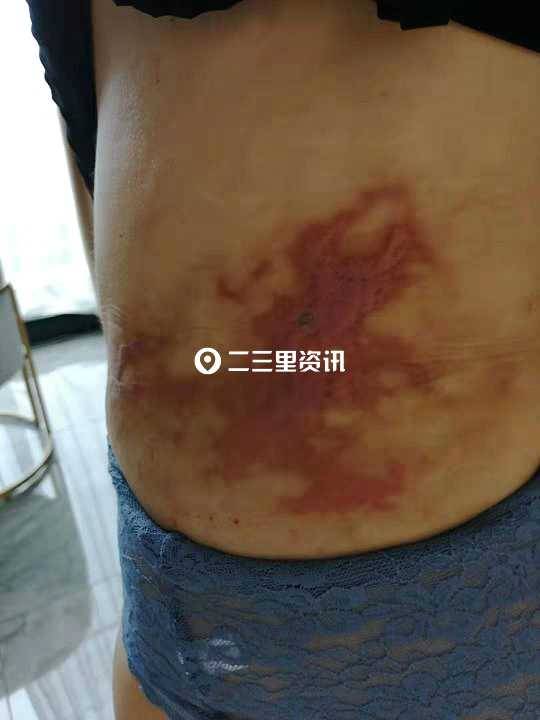 吉林市女子抽脂手术后出现瘢痕维权难，瑞鑫医美：对方体质原因导致