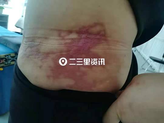 吉林市女子抽脂手术后出现瘢痕维权难，瑞鑫医美：对方体质原因导致