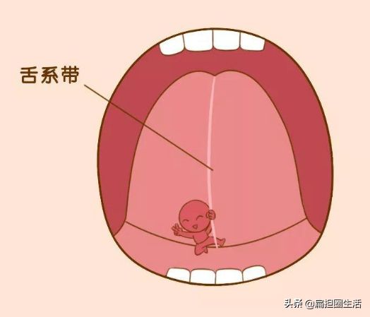 大舌头患者？不用害怕，你需要用4个办法进行训练矫正
