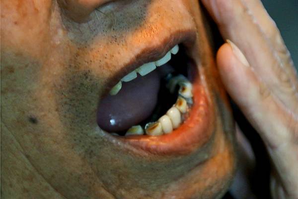 舌头疼、有白斑，是口腔溃疡还是舌癌？3类高危人群需重视