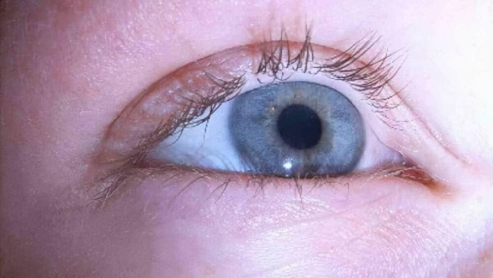 青光眼有哪些症状？如何判断呢？