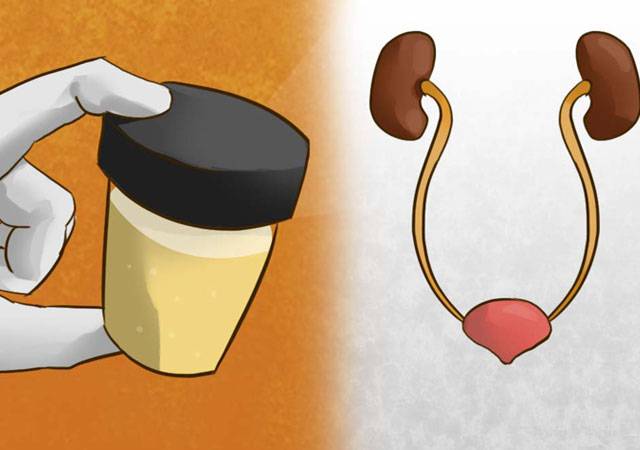 你知道蛋白尿是什么吗？你的尿液含有蛋白质的征兆是什么？