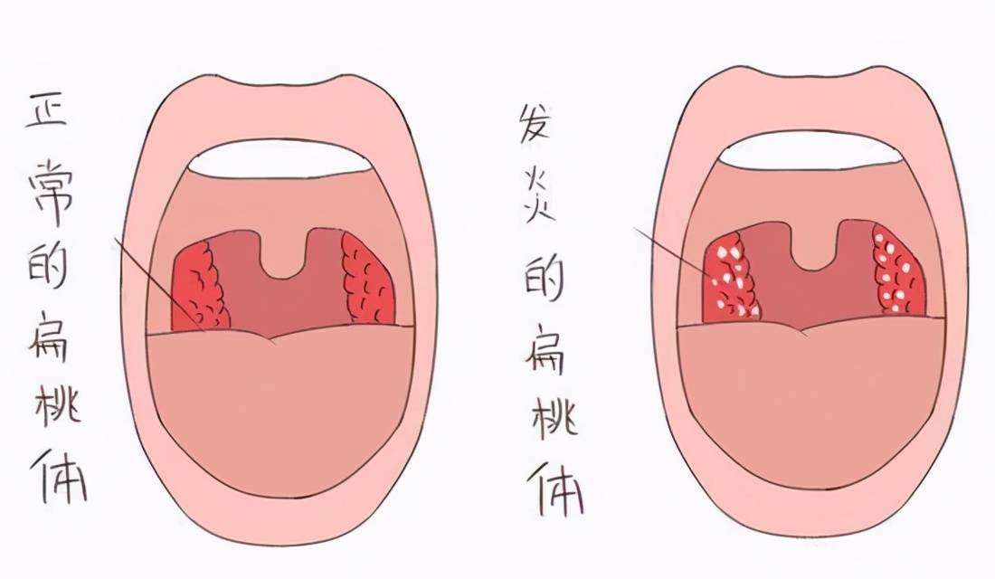 扁桃体炎为什么反反复复？怎么才能从根本上解决问题？