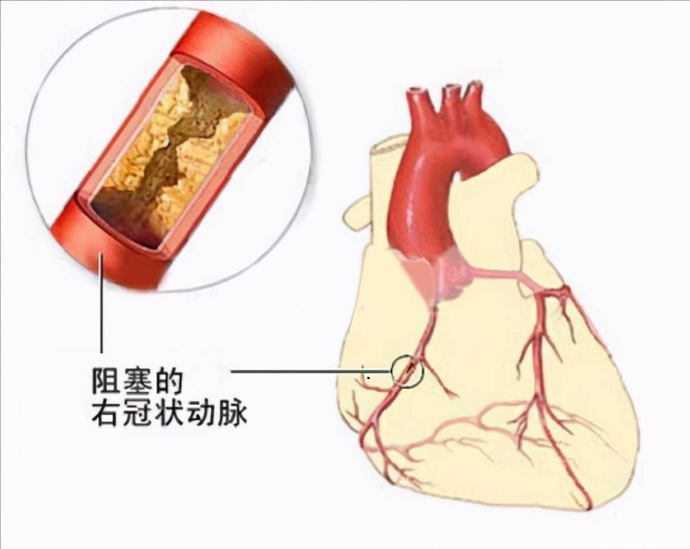 医生是如何给冠心病患者做冠脉造影的？一文看懂导管从手臂进入心脏的过程