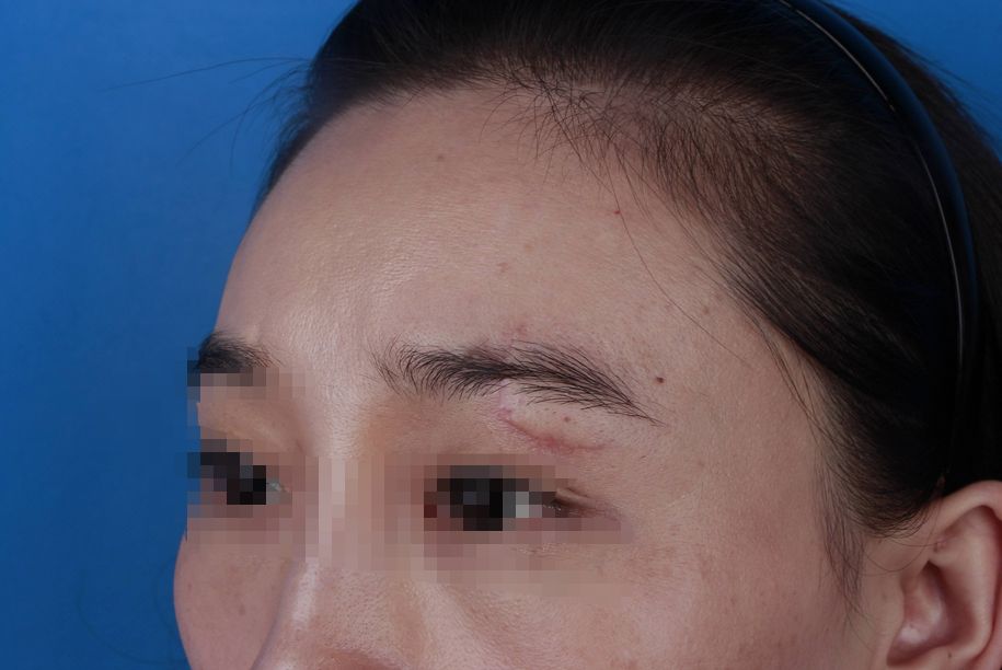 脸上不小心留下疤痕，有什么修复方法呢？