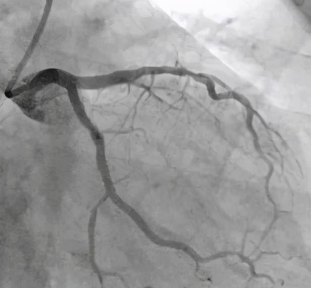 医生是如何给冠心病患者做冠脉造影的？一文看懂导管从手臂进入心脏的过程