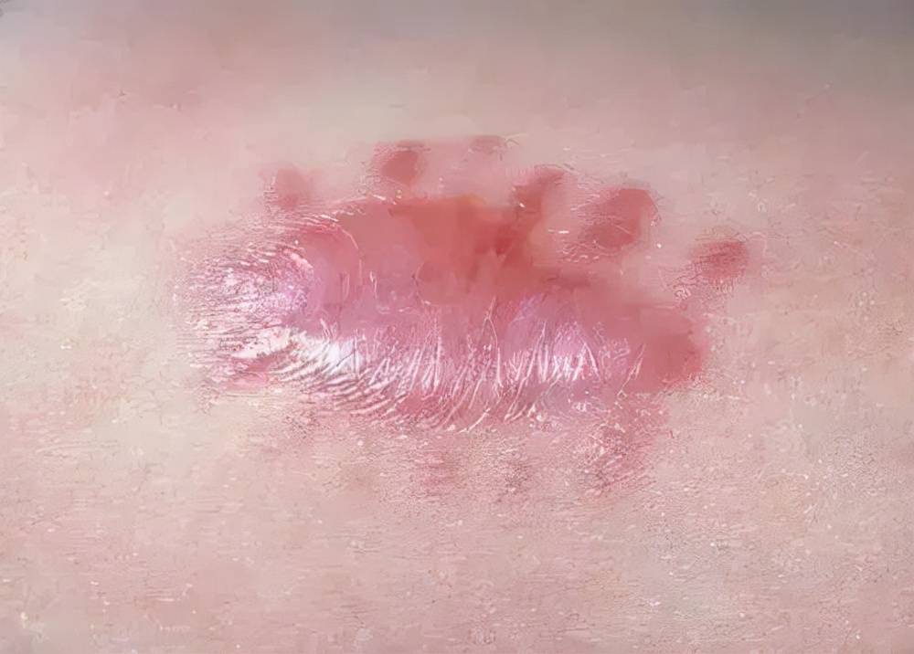 增生疤痕怎么治疗？